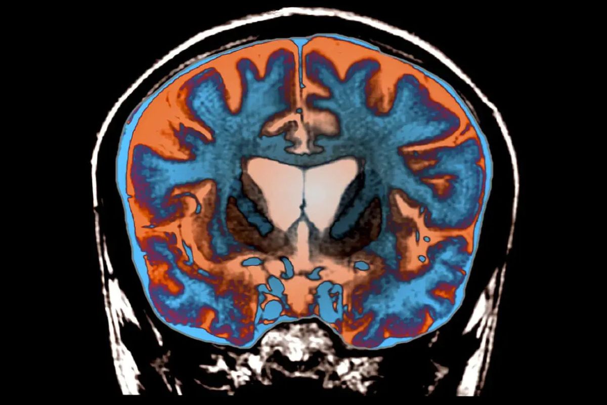 34 Facts About Huntington's Disease